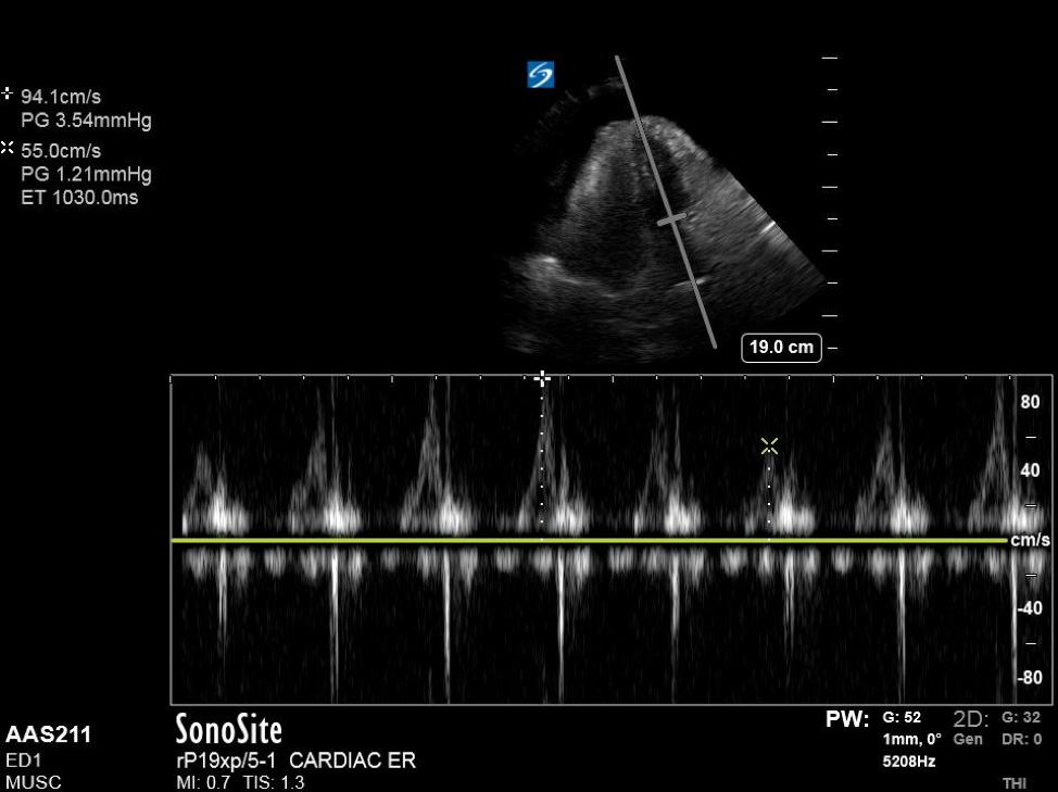 Figure 4 - Apical 4-chamber view with excessive variation in mitral inflow velocities.jpg