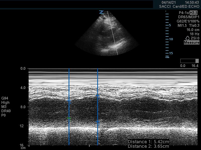 figure 7 - normal fractional shortening short axis.jpg