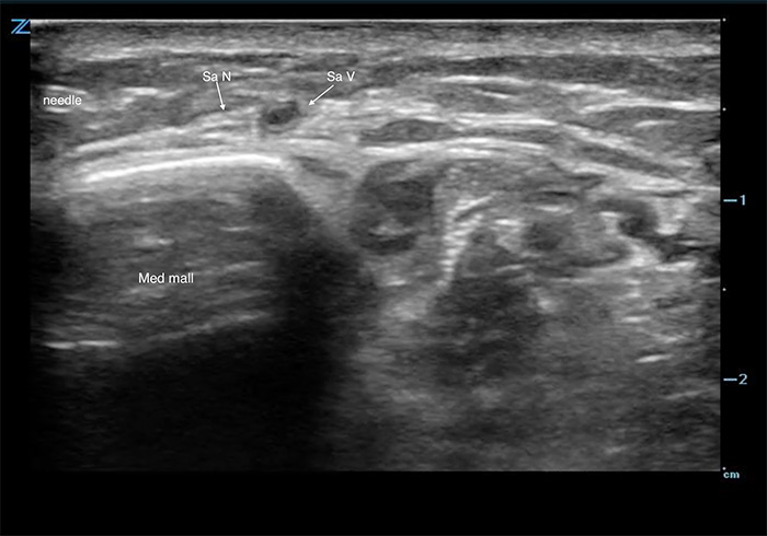 Figure 1. Saphenous nerve.jpg