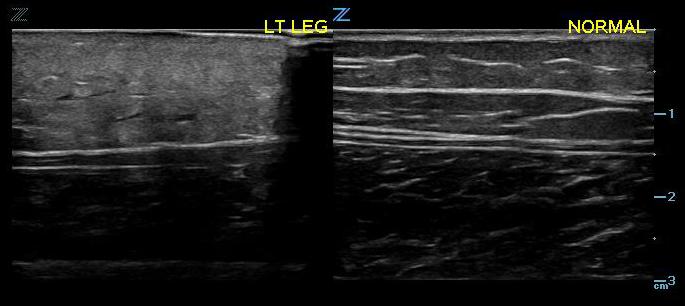 Figure 3. early cellulitis (left) compared with normal (right).jpg