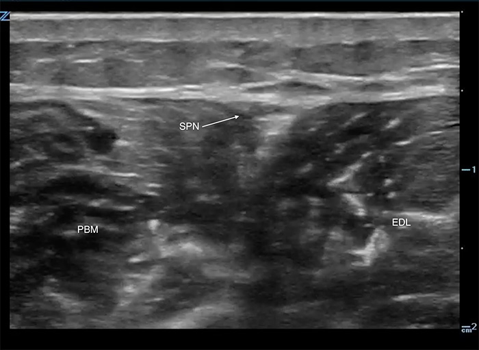 Figure 1. Superficial peroneal nerve.jpg