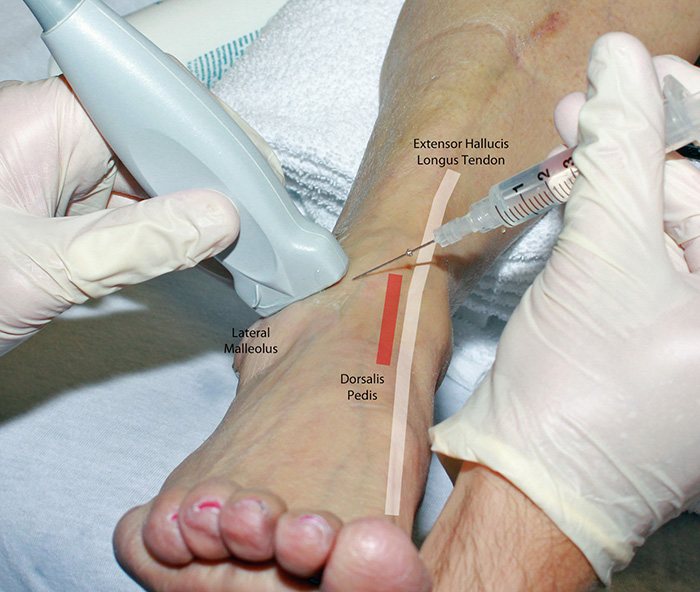 Figure 2. Superficial peroneal nerve block at ankle in-plane hands.jpg