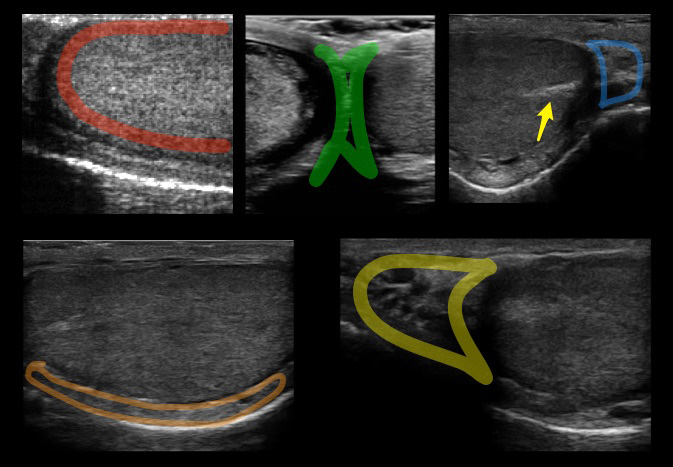 Figure 3_Testicle_US_Anatomy Marked.jpg