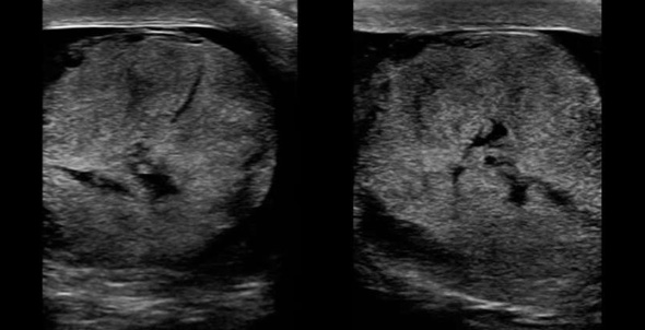Figure 7_ Testicular Fracture Diagram.jpg