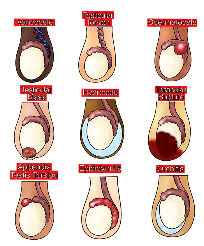 Illustration 2. Schematic overview of testicular pathology.jpg