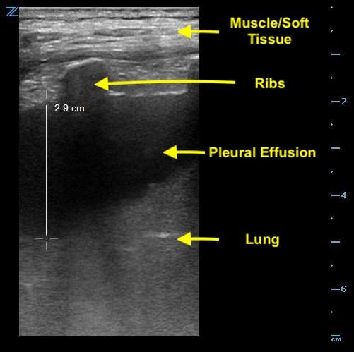 Thoracentesis Figure 3 - Measurement of depth to lung parenchyma.jpg
