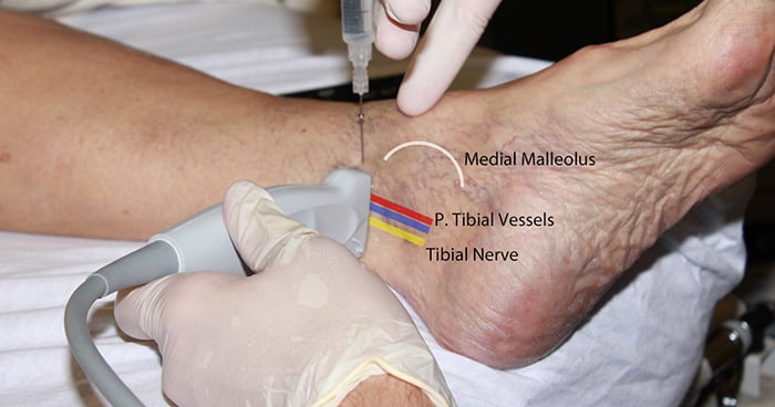 Figure 1. Tibial Hands position in-plane.jpg