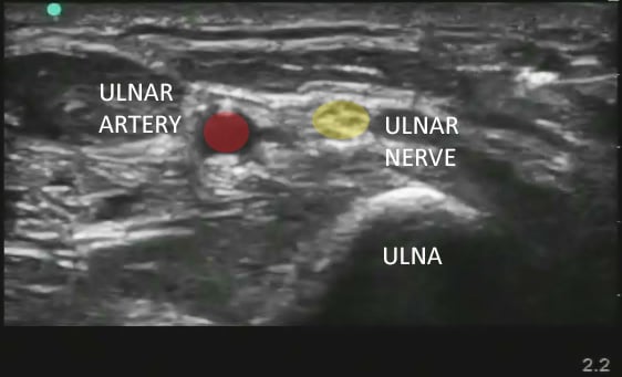 Figure 1. Ulnar nerve with labels.jpg