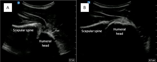 May2025-Pedi Interscalene_Fig 1.jpg