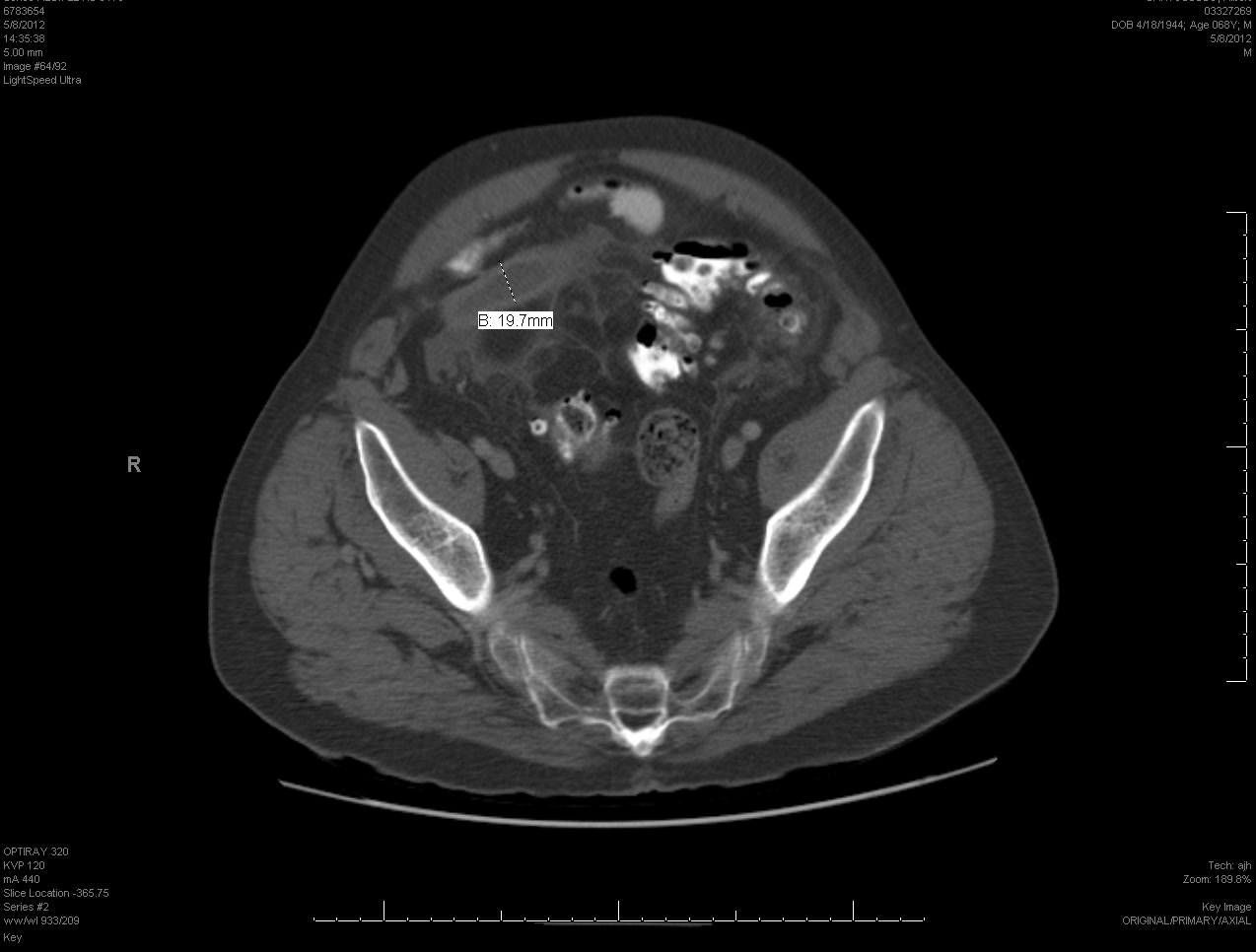 CT of ruptured appy.jpg