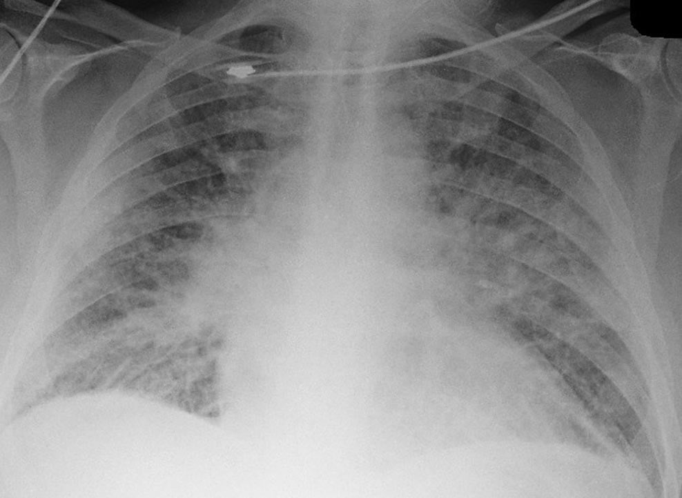 CXR-PulmCongestion.jpg