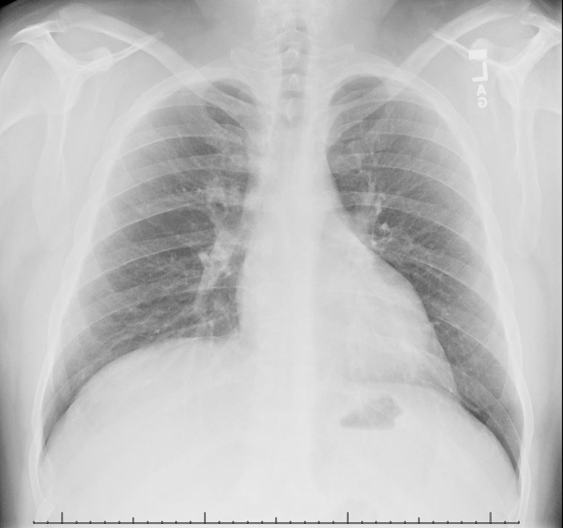 cxr.JPG