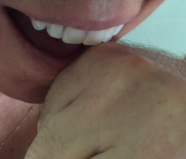 Fight Bite Vignette Pic Fight Bite Vignette Pic