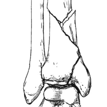 Open Fracture Leg Vignette Pic