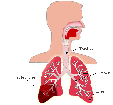 ICD-10 Pneumonia Vignette ICD-10 Pneumonia Vignette